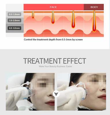 HIFU Beauty Machine 5.0-25mm Portable Skin Tightening Device